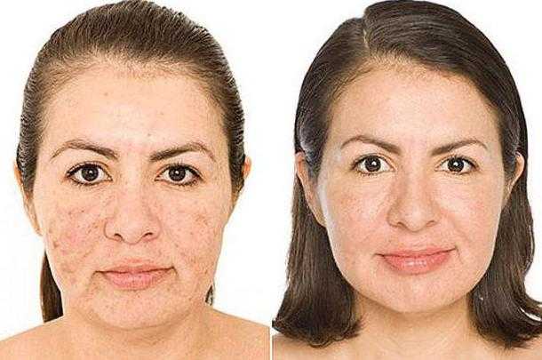 Эффективная процедура для обновления кожи — abr-пилинг. особенности проведения